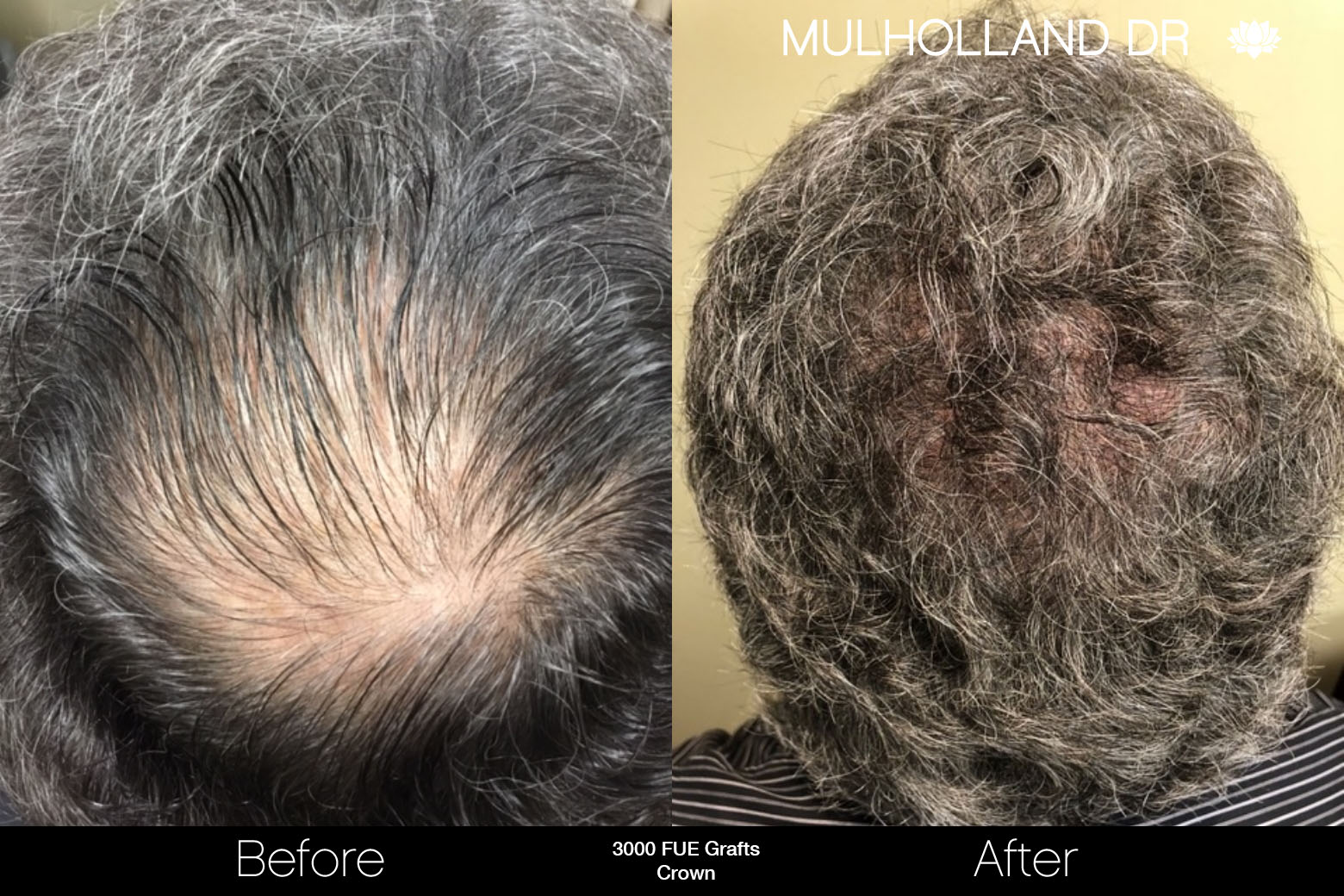 FUE Hair Male - Before and After Gallery – Photo 76