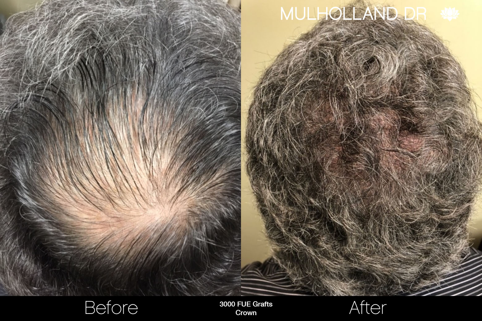 Halifax FUE Hair Transplant | SpaMedica Halifax FUE Hair Transplant | SpaMedica