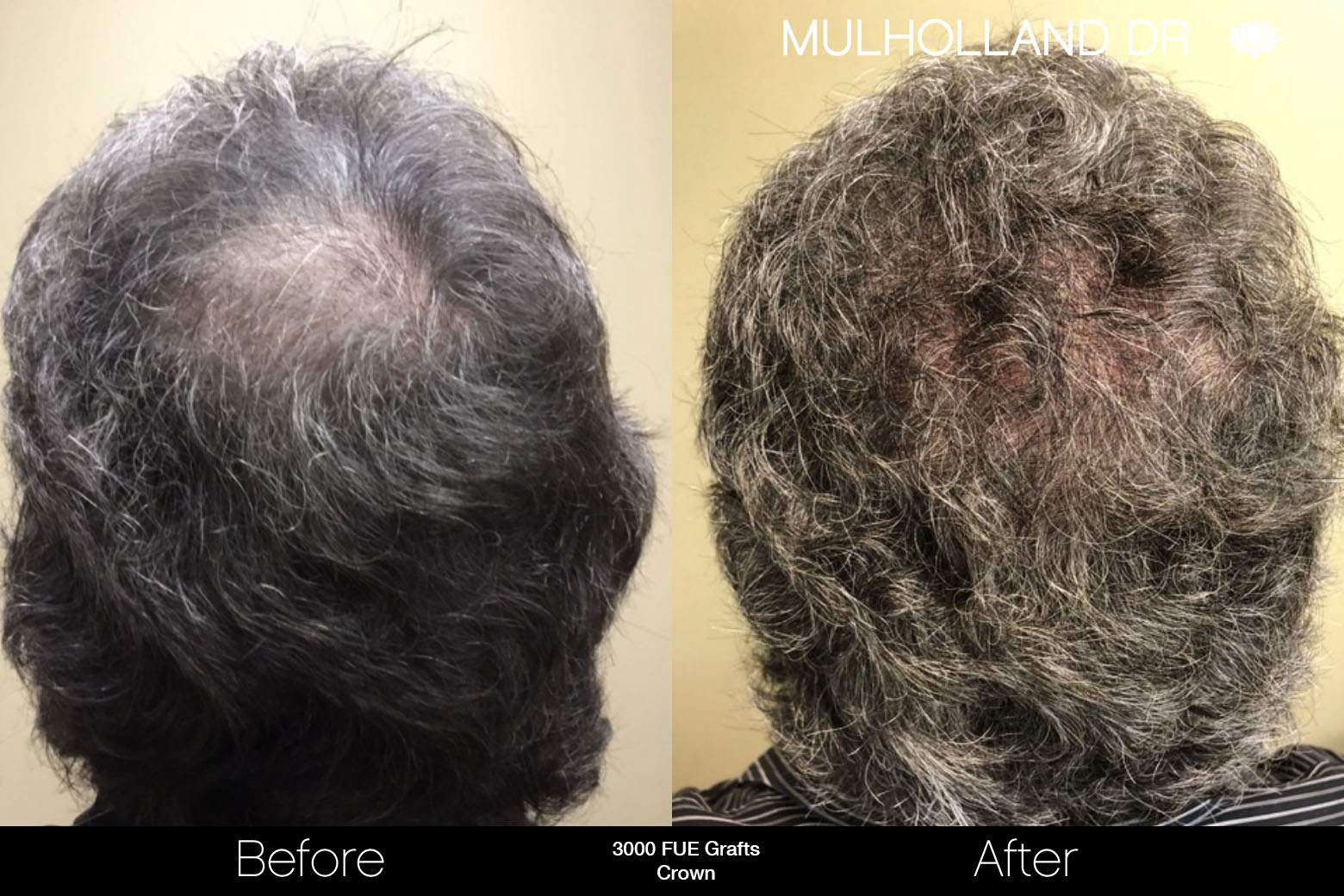 FUE Hair Male - Before and After Gallery – Photo 77