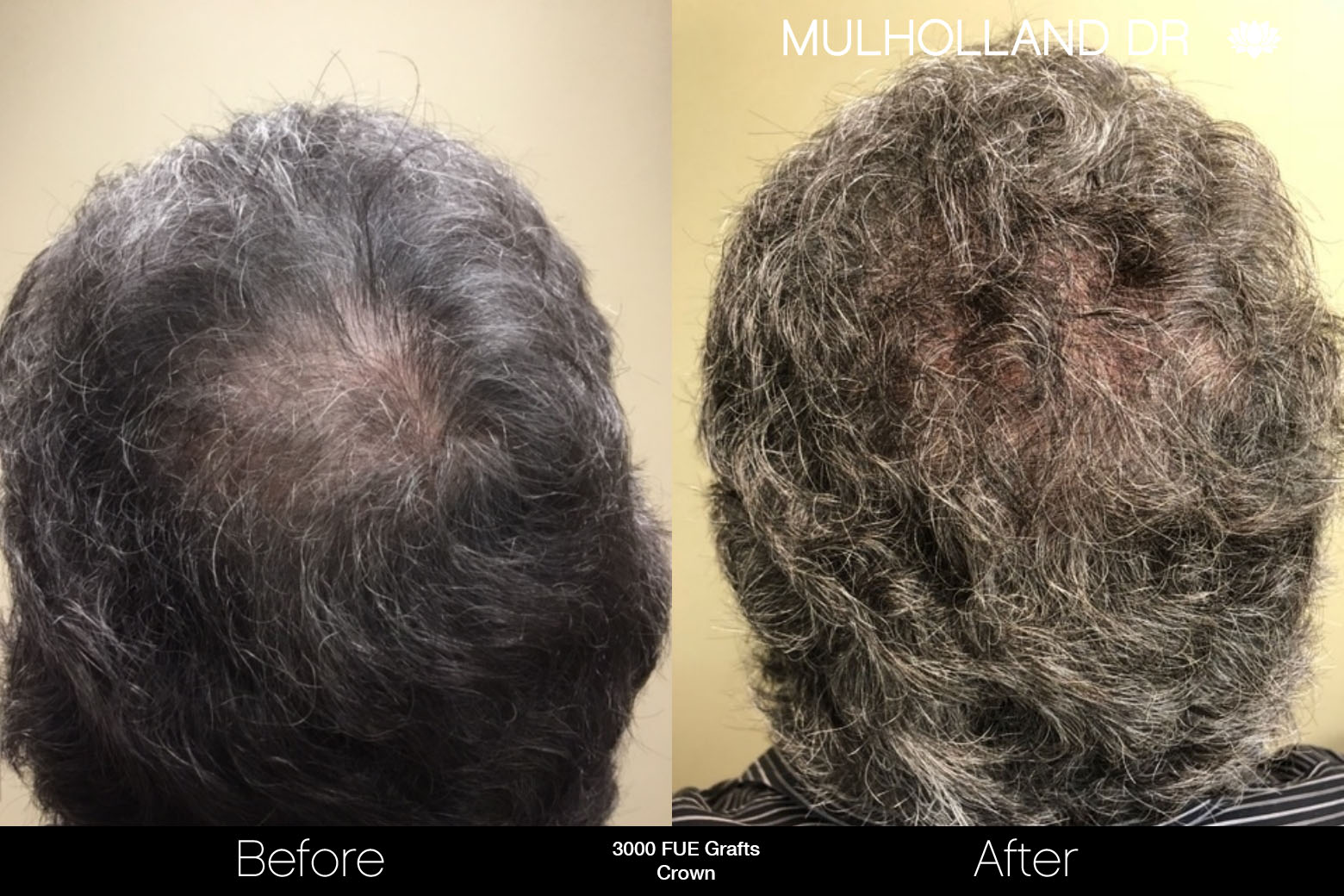 FUE Hair Male - Before and After Gallery – Photo 78