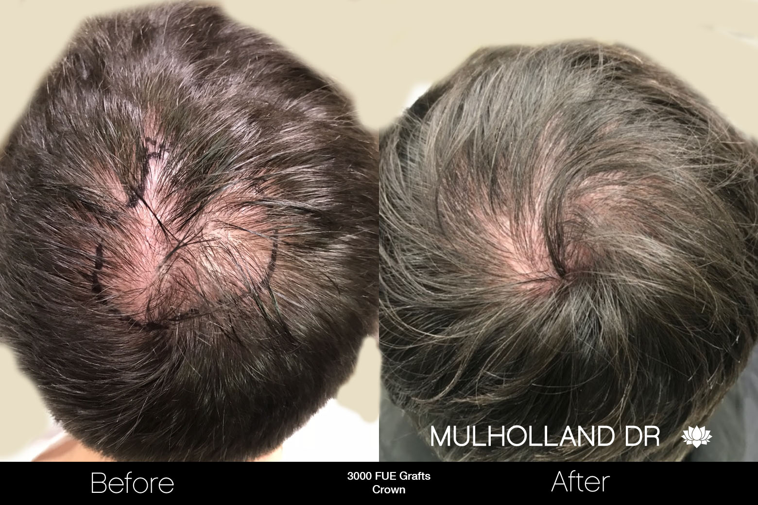 FUE Hair Male - Before and After Gallery – Photo 79