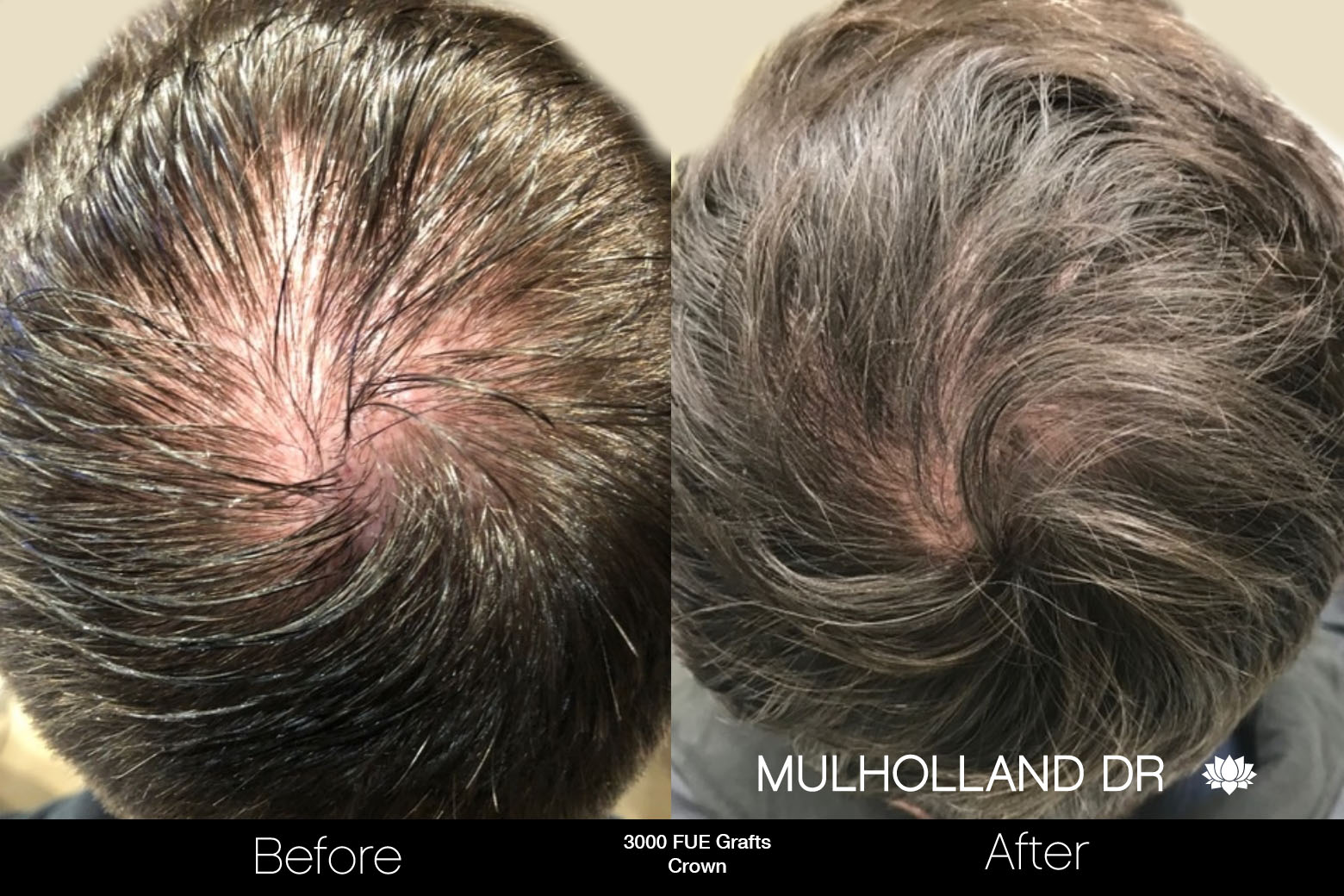 FUE Hair Male - Before and After Gallery – Photo 80