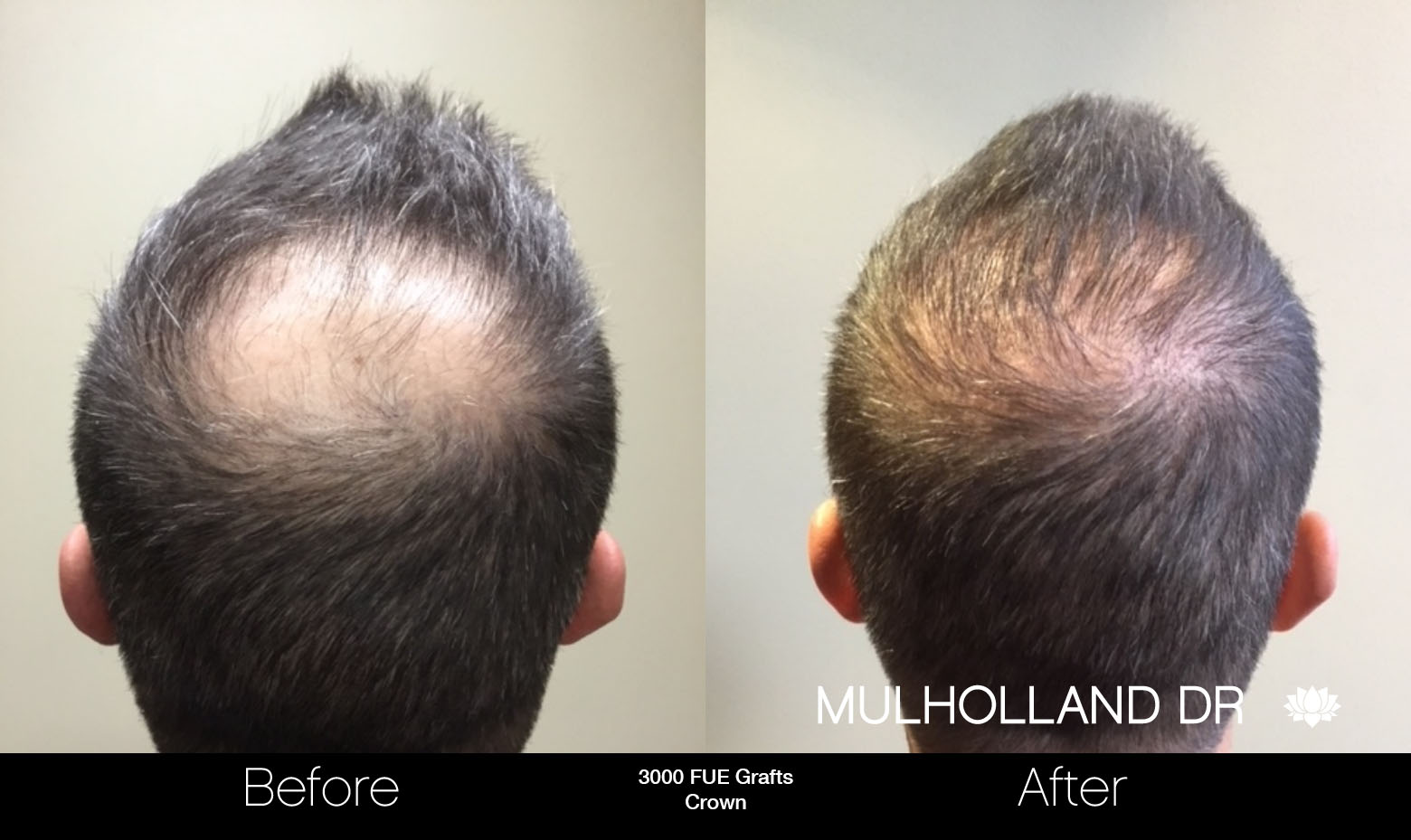 FUE Hair Male - Before and After Gallery – Photo 81