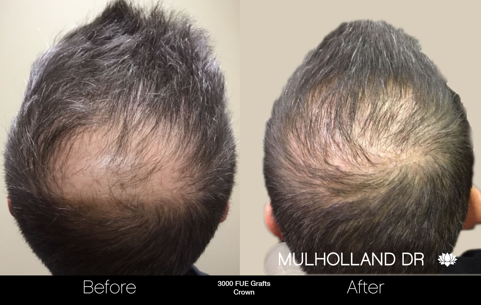 FUE Hair Male - Before and After Gallery – Photo 82