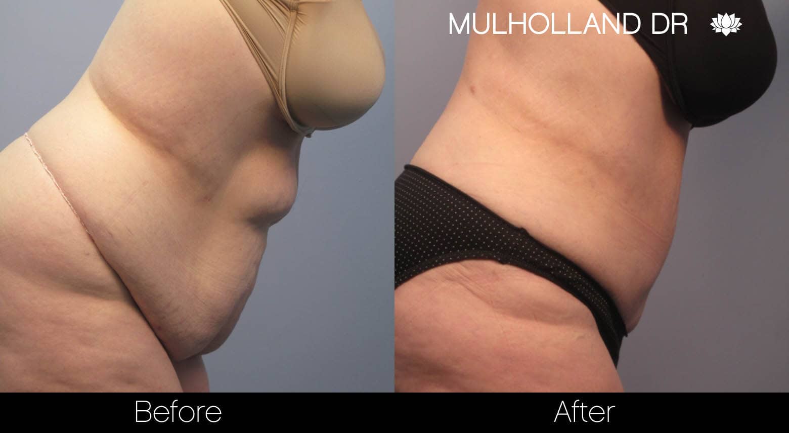 Liposuction - Before and After Gallery – Photo 8
