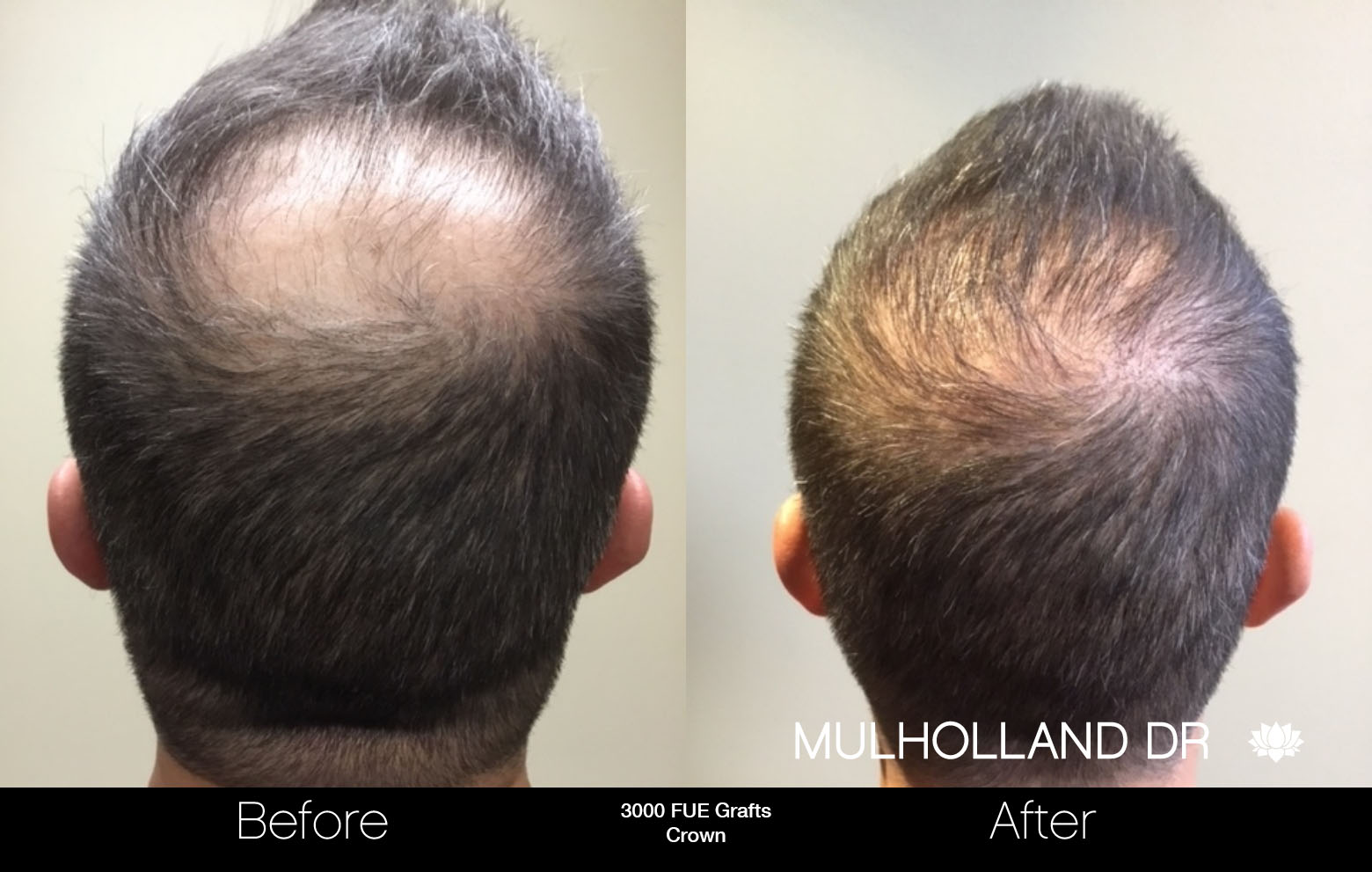 FUE Hair Male - Before and After Gallery – Photo 83