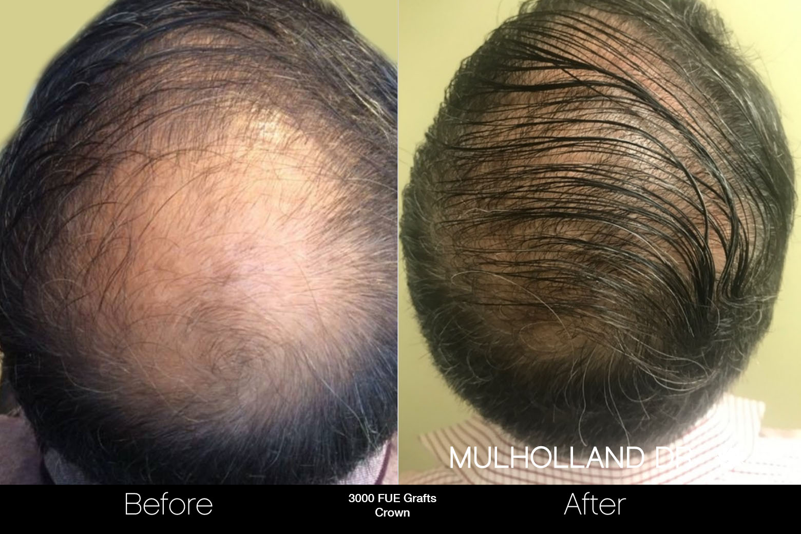 FUE Hair Male - Before and After Gallery – Photo 84