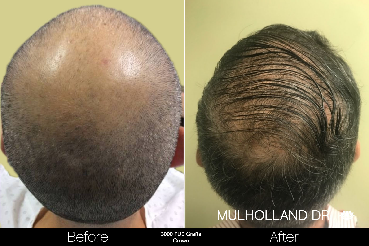 FUE Hair Male - Before and After Gallery – Photo 85