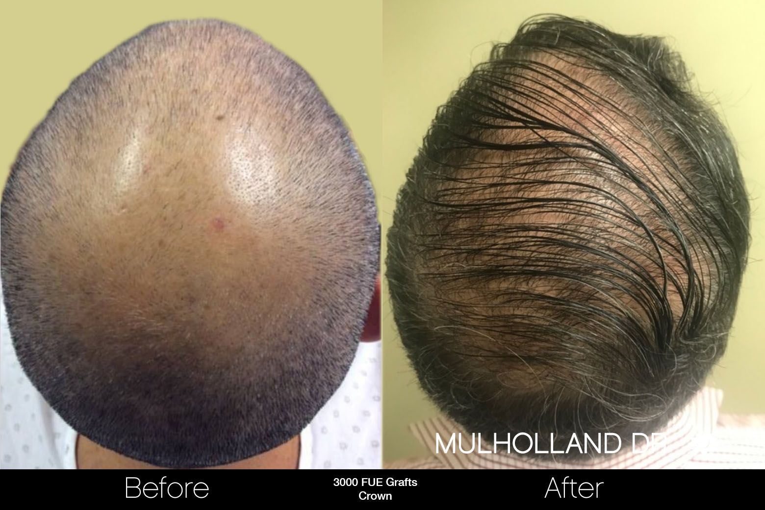 FUE Hair Male - Before and After Gallery – Photo 86