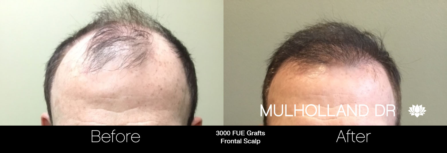 FUE Hair Male - Before and After Gallery – Photo 87