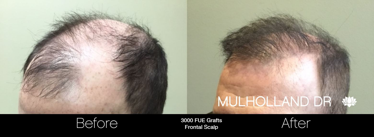 FUE Hair Male - Before and After Gallery – Photo 88