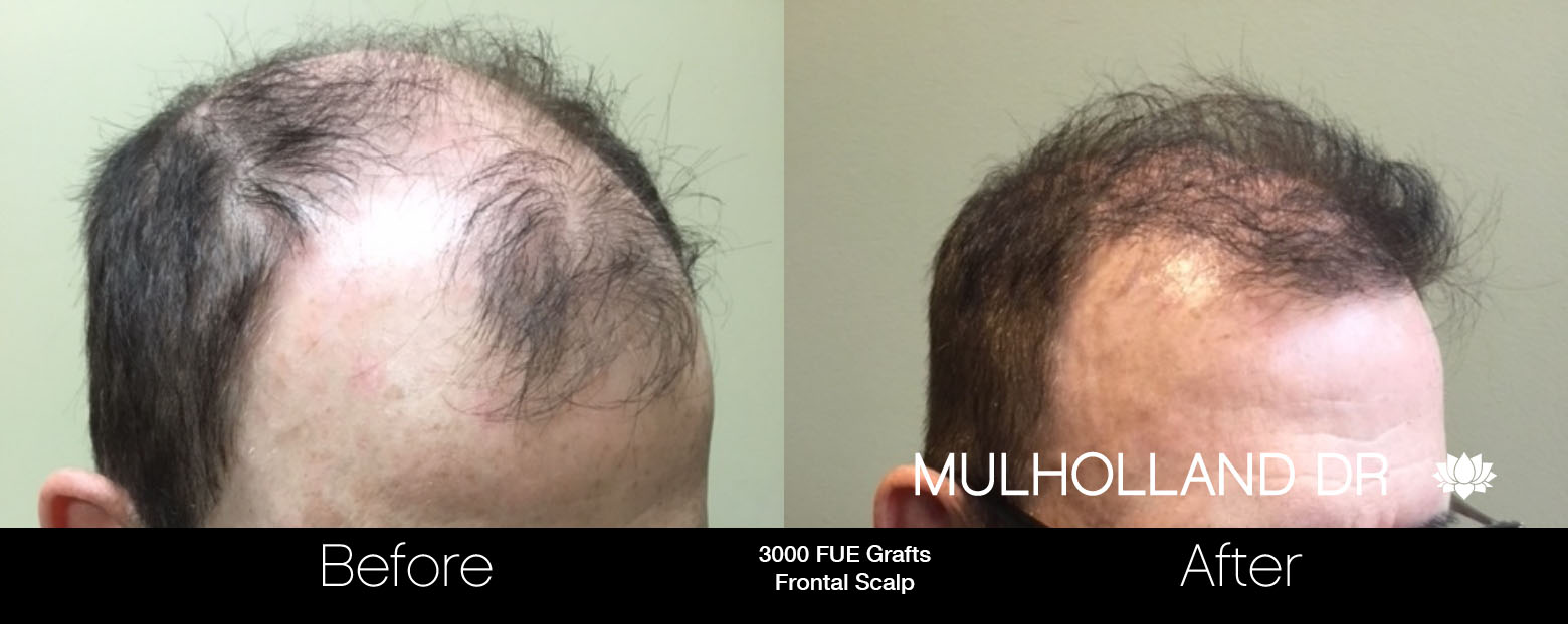 FUE Hair Male - Before and After Gallery – Photo 89