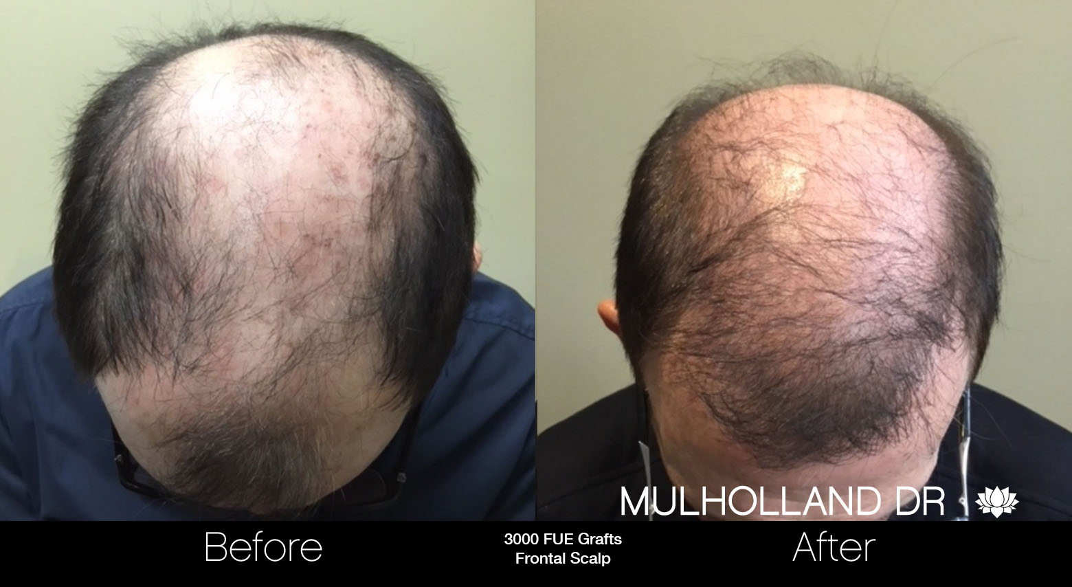 FUE Hair Male - Before and After Gallery – Photo 90