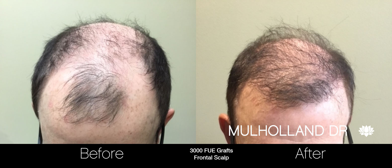 FUE Hair Male - Before and After Gallery – Photo 91