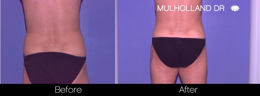 BodyTite Liposuction - Before and After Gallery – Photo 101