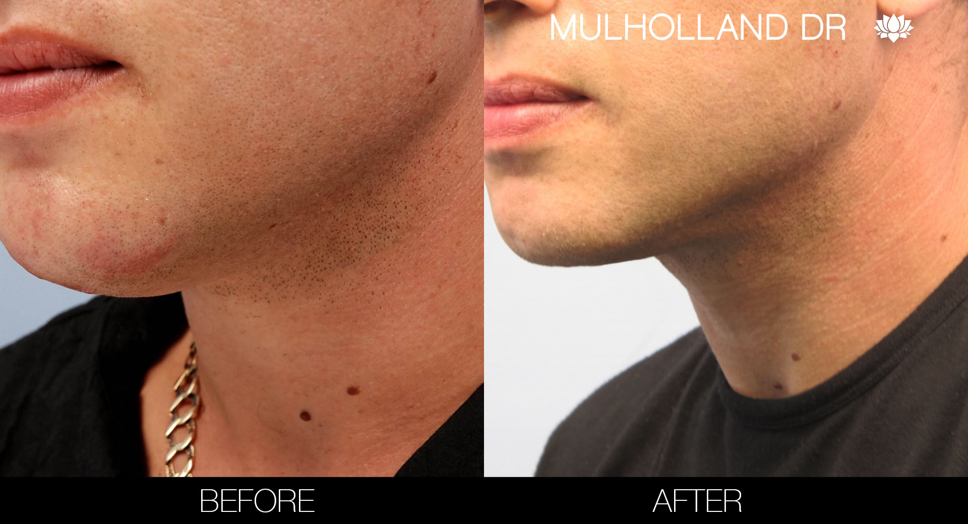 Liposuction - Before and After Gallery – Photo 103