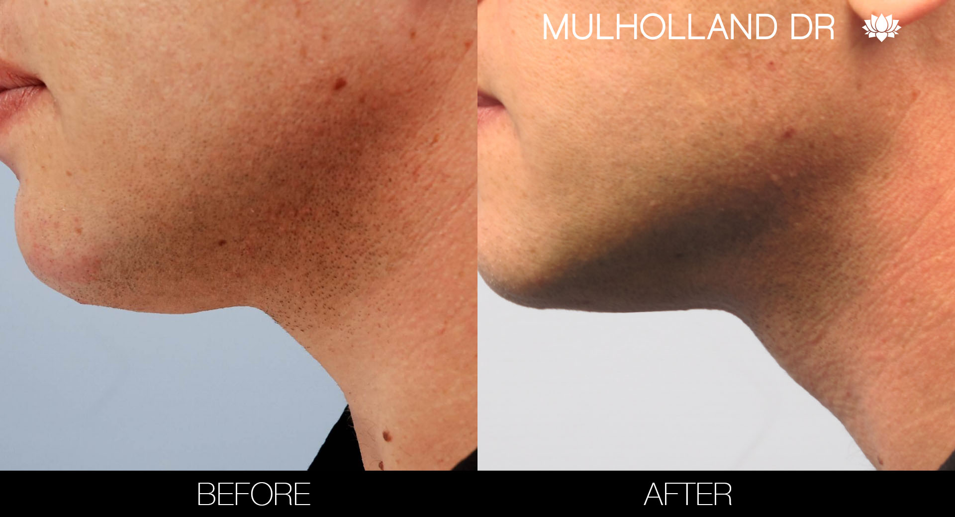 Liposuction - Before and After Gallery – Photo 104