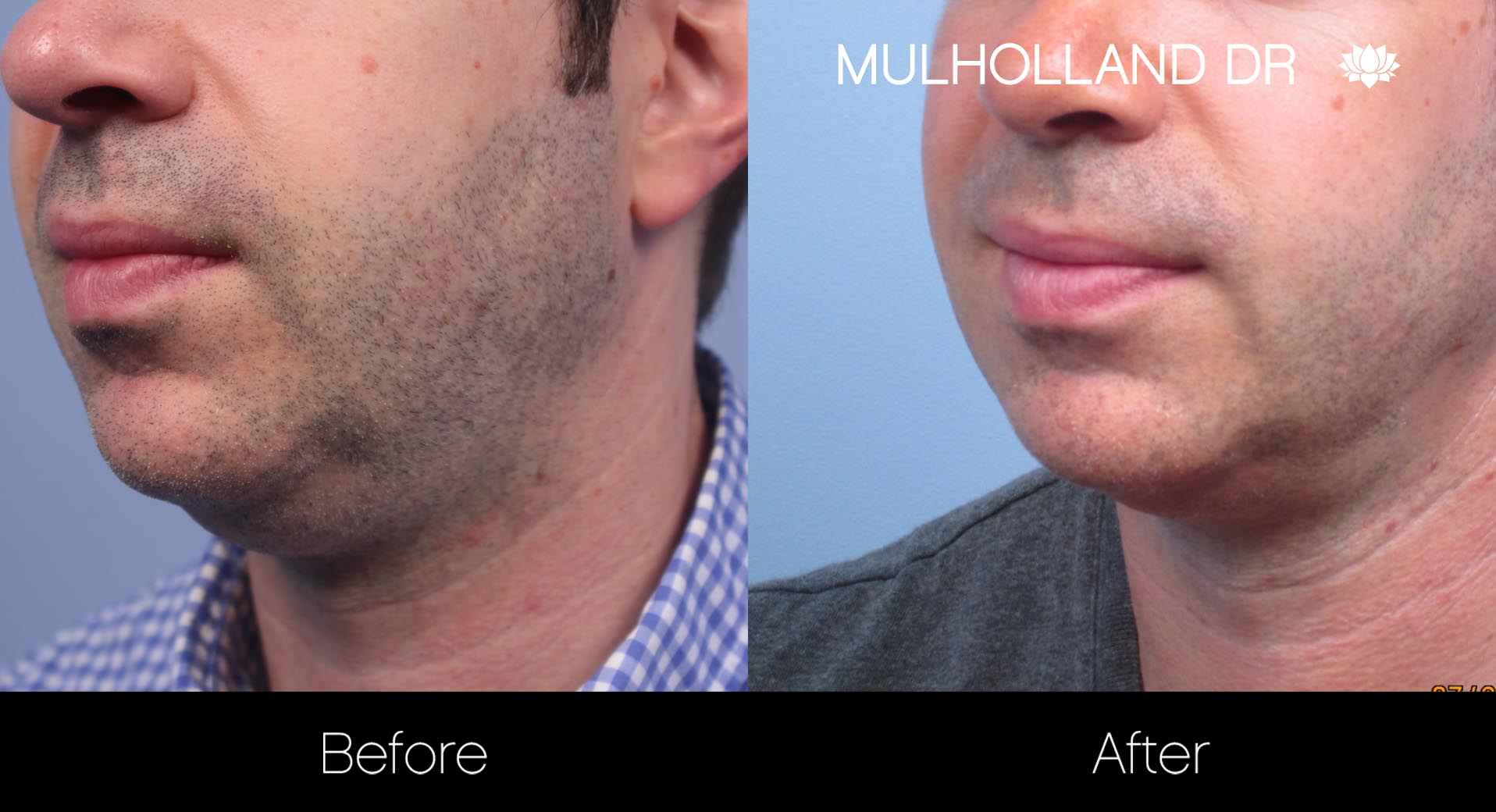 Liposuction - Before and After Gallery – Photo 111