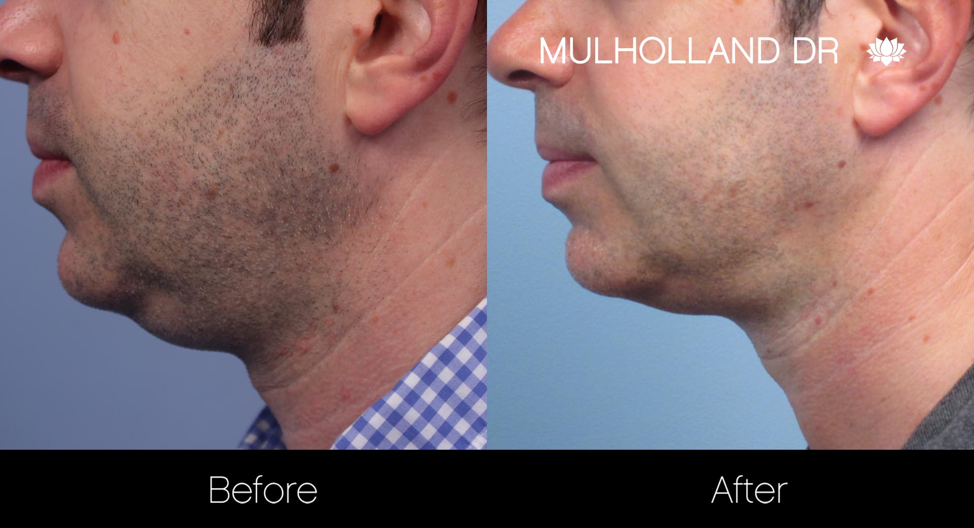 Liposuction - Before and After Gallery – Photo 112