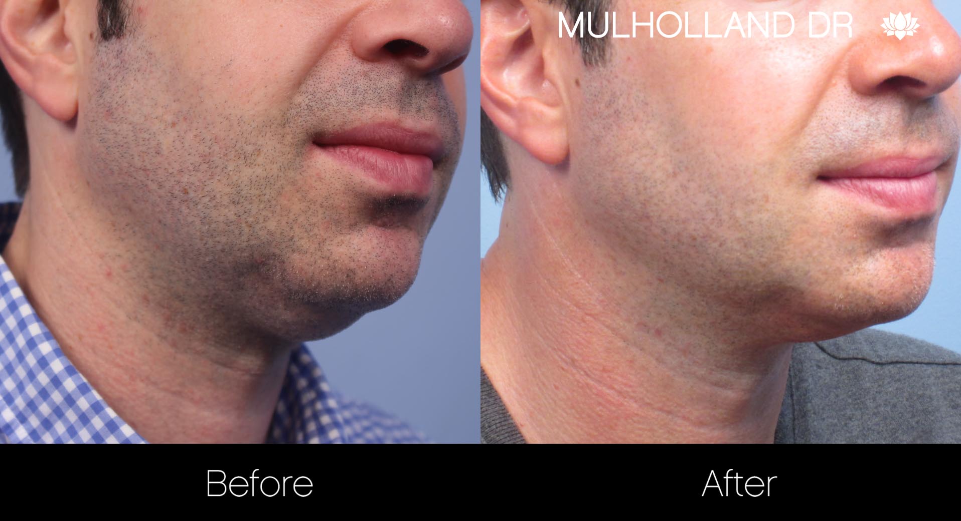 Liposuction - Before and After Gallery – Photo 113