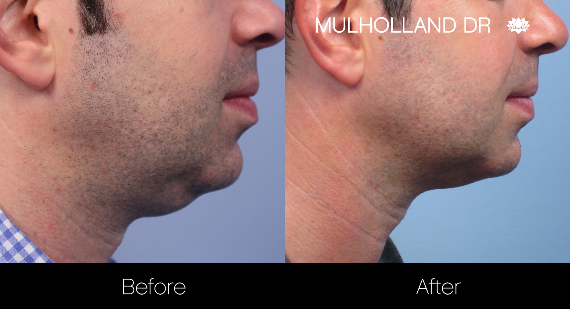 Liposuction - Before and After Gallery – Photo 114