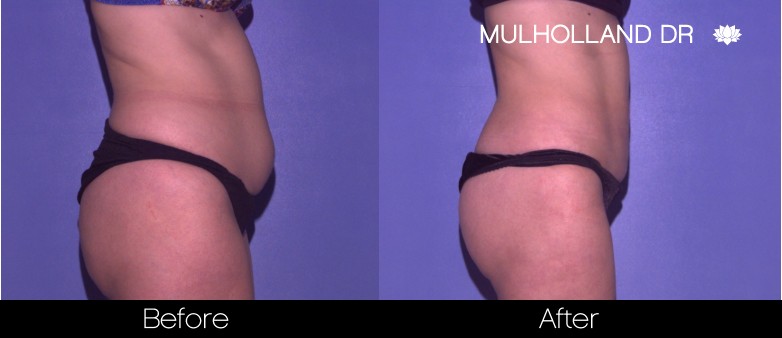 BodyTite Liposuction - Before and After Gallery – Photo 18