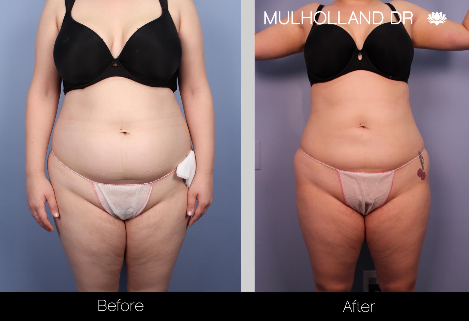 BodyTite Liposuction - Before and After Gallery – Photo 22