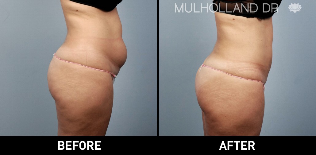 BodyTite Liposuction - Before and After Gallery – Photo 30