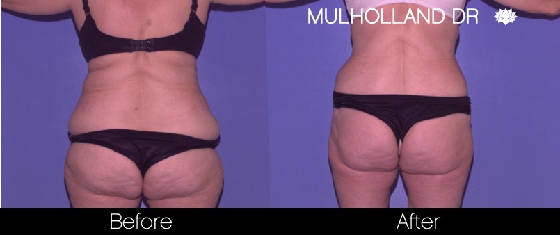 BodyTite Liposuction - Before and After Gallery – Photo 33