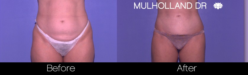 Liposuction - Before and After Gallery – Photo 37