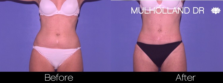 Liposuction - Before and After Gallery – Photo 38