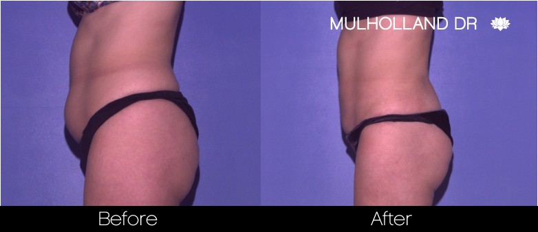 Liposuction - Before and After Gallery – Photo 40