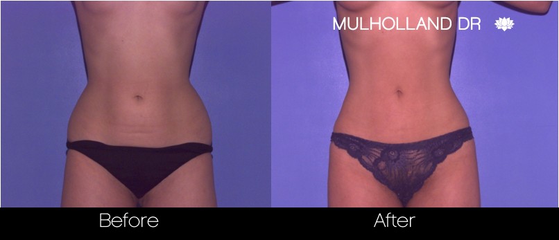 Liposuction - Before and After Gallery – Photo 41