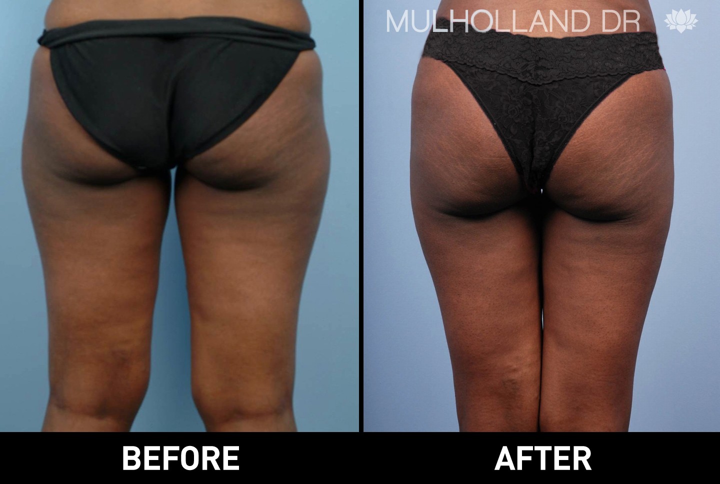 BodyTite Liposuction - Before and After Gallery – Photo 41