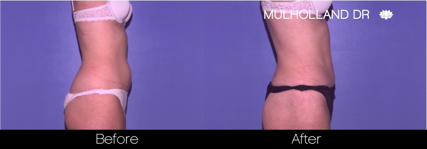 Liposuction - Before and After Gallery – Photo 41