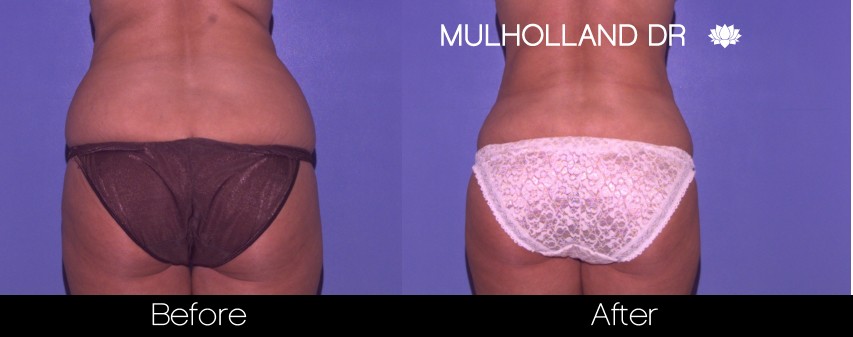 Liposuction - Before and After Gallery – Photo 47