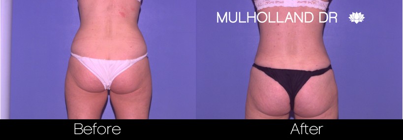 Liposuction - Before and After Gallery – Photo 40