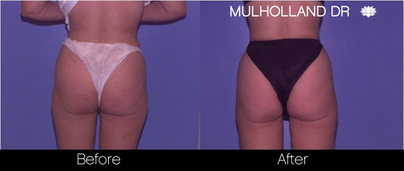 BodyTite Liposuction - Before and After Gallery – Photo 50