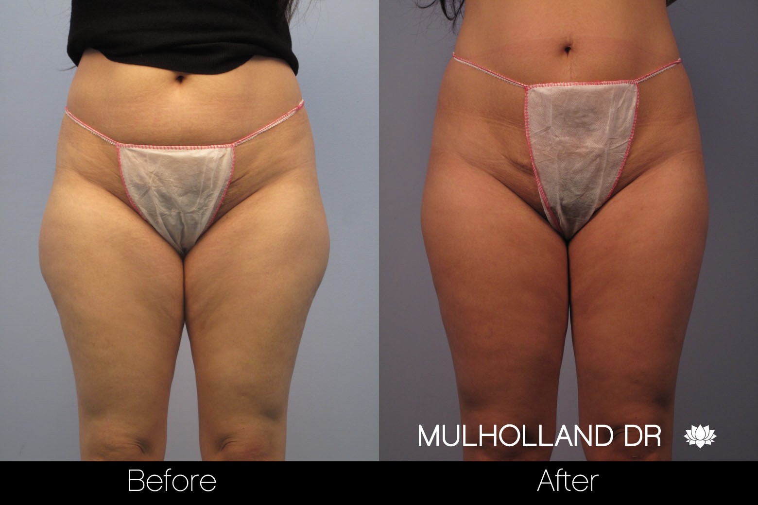 Liposuction - Before and After Gallery – Photo 48