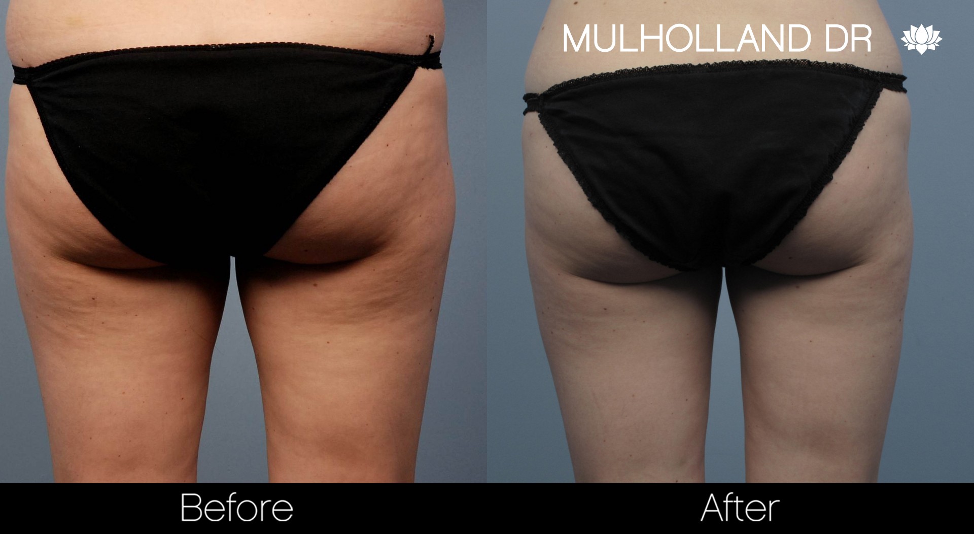 Liposuction - Before and After Gallery – Photo 50