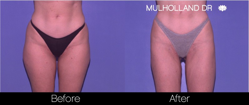 Liposuction - Before and After Gallery – Photo 52
