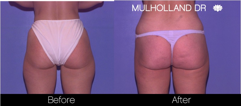 Liposuction - Before and After Gallery – Photo 54