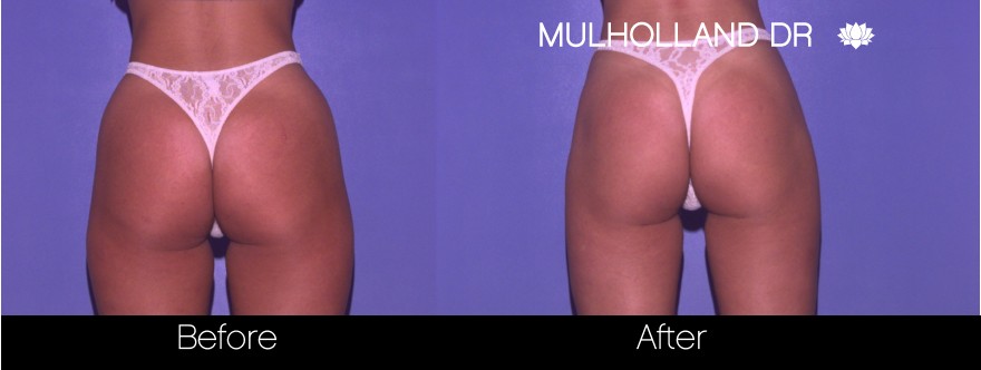 Liposuction - Before and After Gallery – Photo 55