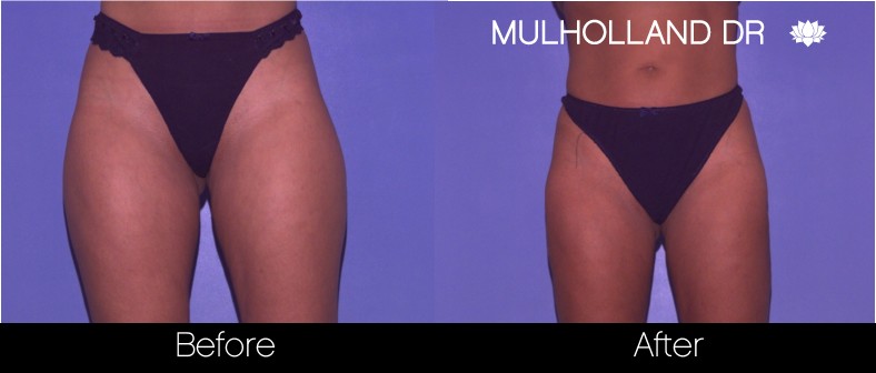 Liposuction - Before and After Gallery – Photo 57