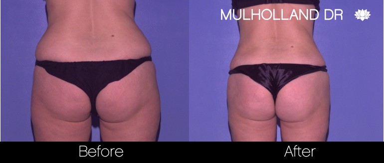 Liposuction - Before and After Gallery – Photo 58