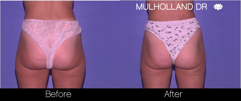 Liposuction - Before and After Gallery – Photo 59