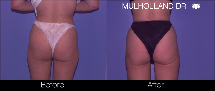 Liposuction - Before and After Gallery – Photo 60