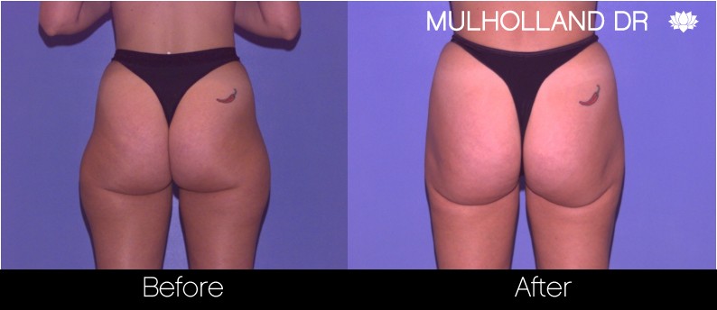Liposuction - Before and After Gallery – Photo 60
