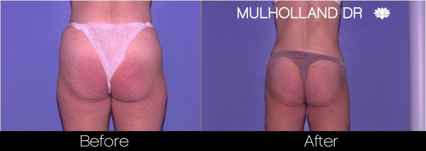 Liposuction - Before and After Gallery – Photo 61