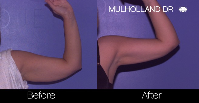 Liposuction - Before and After Gallery – Photo 65